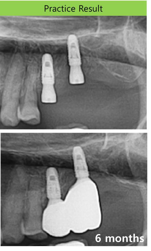 Determination_of_Buccopalatal_orientation_with_reference_of_opposite_tooth.jpg