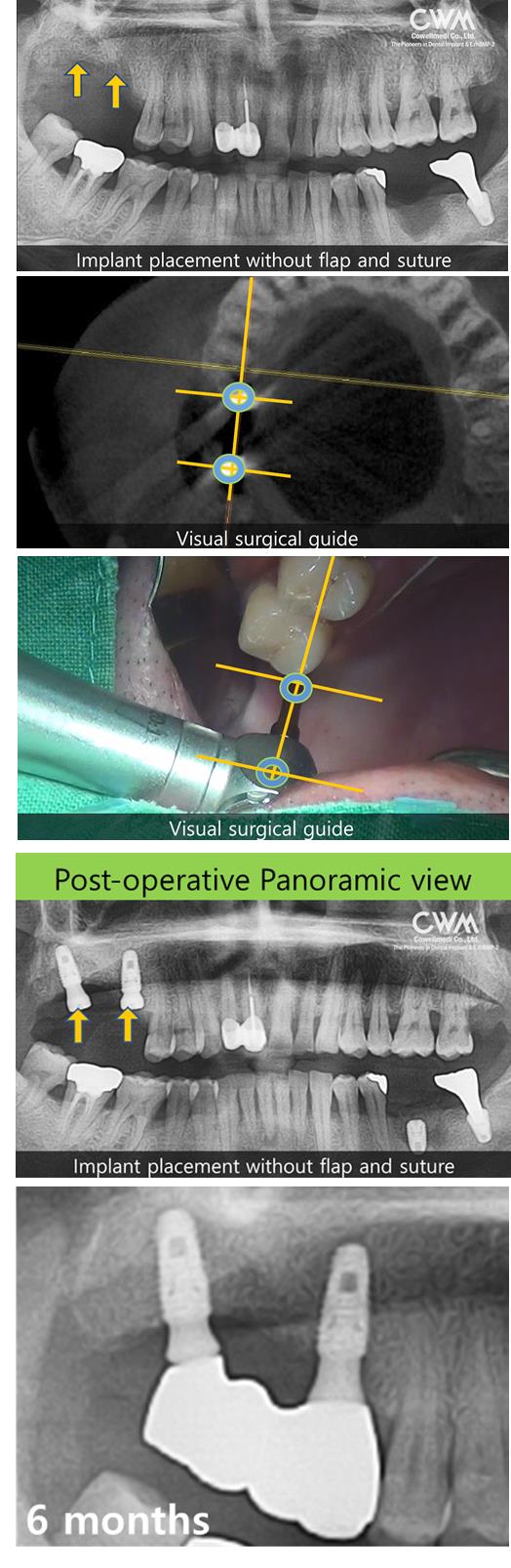 Flapless_surgery_in_two_molar_sites.jpg