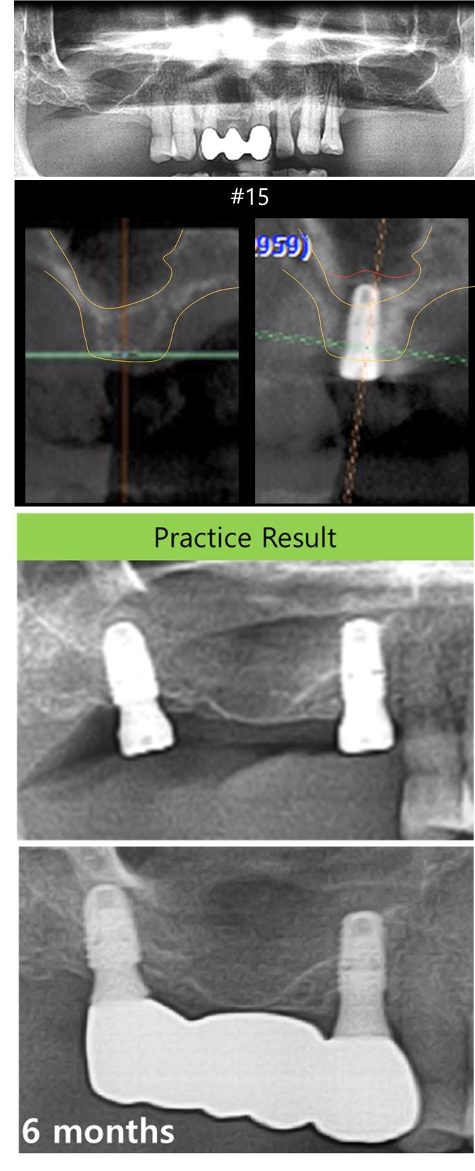 Flapless_surgery_in_Secnd_premolar_and_Secnd_molar.jpg
