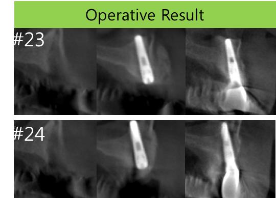 buccal_bone_graft.jpg