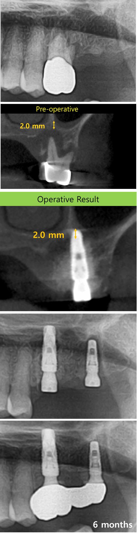 Healing_abutment.jpg