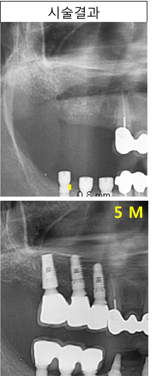 BOSS_type2&Titanium_plate.jpg