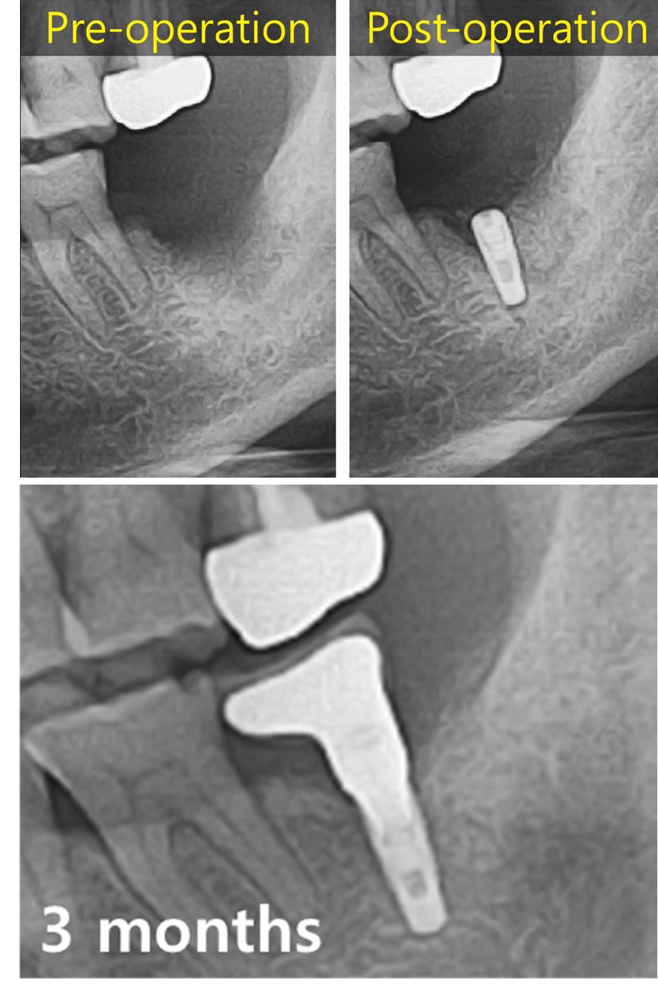 Escaped_implant_placement_from_mandibular_canal.jpg