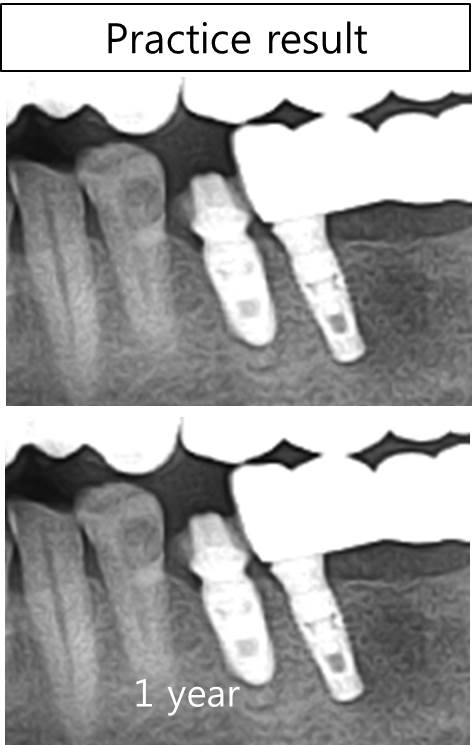 provisional crown on absolute abutment.jpg