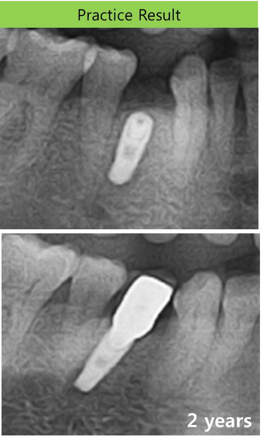 Apical_positioned_flap.jpg