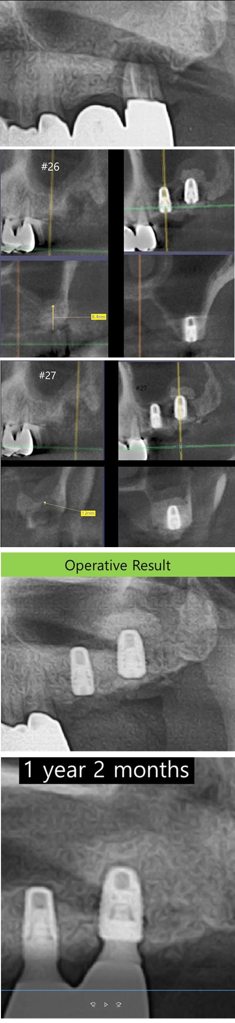 Collagen_membrane_coverage_of_Sinus_membrane_perforation.jpg